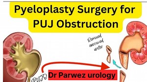 114K views · 3K reactions | Detail about PUJO || PYELOPLASTY || Ureterocalicostomy #parwezurology #Urology #pujo | Parwez urology | Facebook