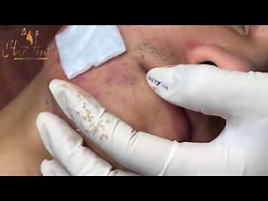Hien Nguyen Acne #214