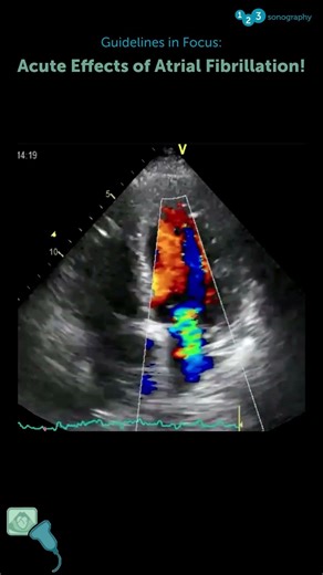 Acute effects on atrial fibrillation!