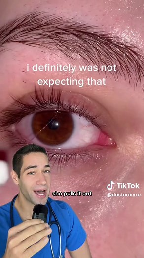 Understanding Mucus Fishing Syndrome in Eyes