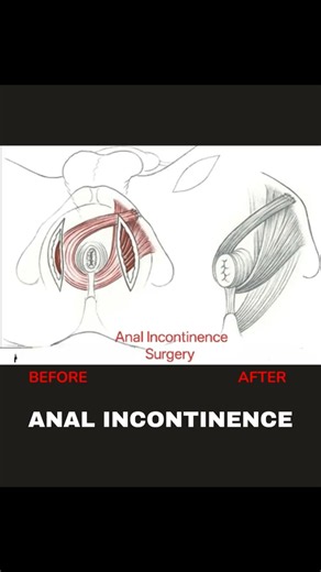 Anal Incontinence Explained | Causes, Symptoms & Treatment Options