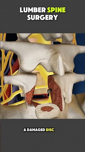 How Lumbar Spine Surgery Is Performed | Step-by-Step Spine Procedure Explained #SpineSurgery