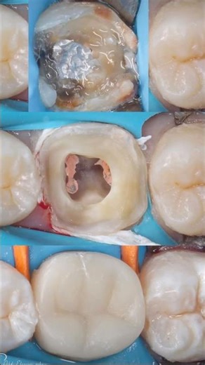 Root canal treatment #rootcanaltreatment #rootcanal #dentist #doctor #smiledesigndental #shorts