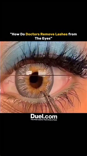 UniverseX on Instagram: "How Do Doctors Remove Lashes from the Eyes? 👁️🩺 Getting an eyelash stuck in your eye can be painful and irritating 😣 When it doesn’t come out naturally, doctors use precise techniques to remove it 🧤 First, they inspect the eye under a slit lamp — a special microscope with light 🔦 This helps them clearly locate the eyelash or any tiny foreign particle 🧬 Before touching the eye, numbing drops are applied to prevent discomfort 💧 Using sterile micro forceps or cotton