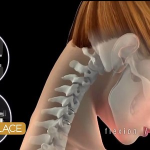 Is disc replacement the right option for you?