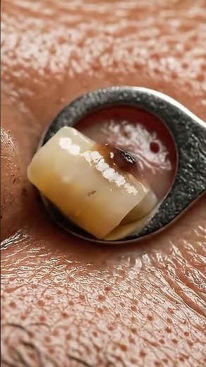 Satisfying Blackhead Pop Near the Nose | ASMR Close-Up