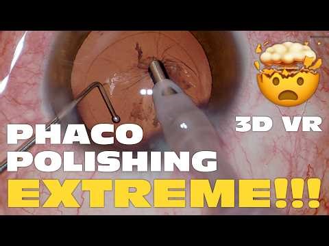 3D Phaco Clip #189 - Extreme Posterior Capsule Phaco Tip Polishing (VR Headset Version)