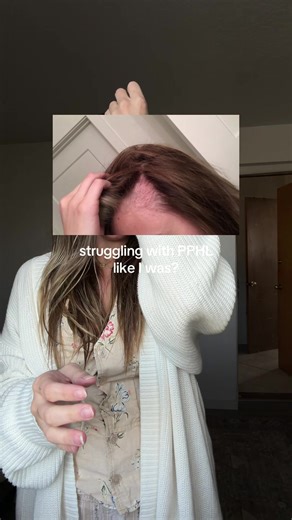 balding at the temples like I was? PPHL is brutal but there are ways to support your scalp during the process 🫶🏼 I’m currently 3 months PP & I’ve been using this serum since I was ~7 months pregnant. The biggest difference I’ve seen is that my hair around my temples is staying strong! That photo was from 2019. I was 6 weeks PP and the hairloss happened overnight, then continued for months until I swapped my products, started eating more, and started exercising. There’s so many things that play