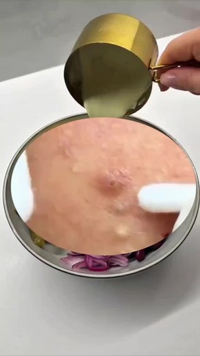 How to Pop Pimples Safely & Satisfyingly