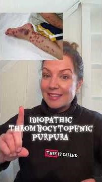 ITP or Idiopathic Thrombocytopenic Purpura is a rare condition in children that causes low platelets