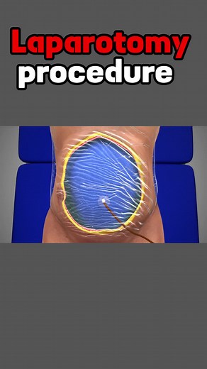 Laparotomy 3d animation #Laparotomy #laparoscopyconvertedtolaparotomy #laparotomyrecovery #laparotomysurgery #procedure #watch #3animation #foryou #foryourpage