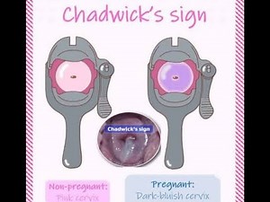 Chadwick’s Sign, JACQUEMIER’S ; indicator of pregnancy, bluish or purplish discoloration of vulva,