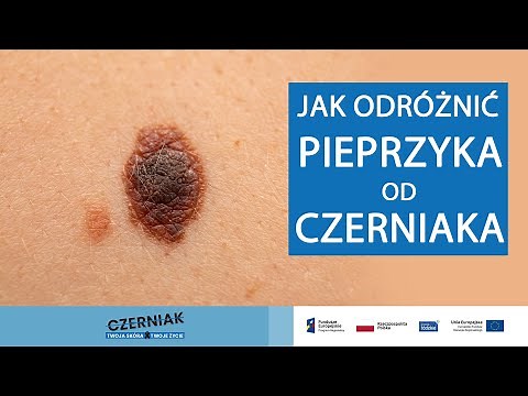 Jak odróżnić pieprzyka od czerniaka?