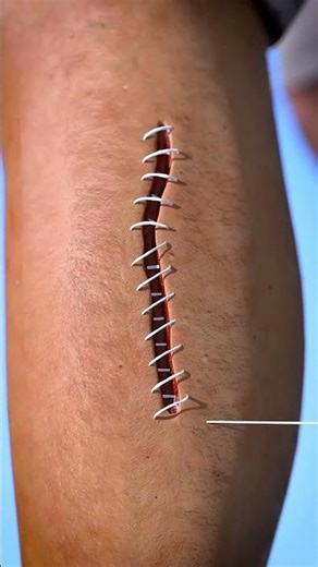 How Doctors Stitch Wounds 😱 | Complete Healing Process Explained