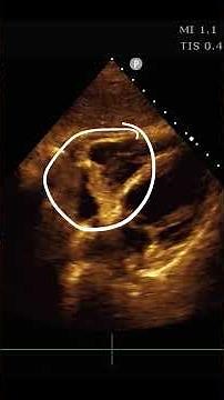 Right Atrial Mass #pocus #ultrasound#echo