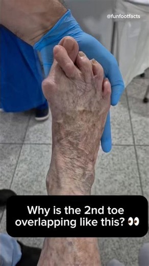 Why Is The 2nd Toe Overlapping Like This? 👣