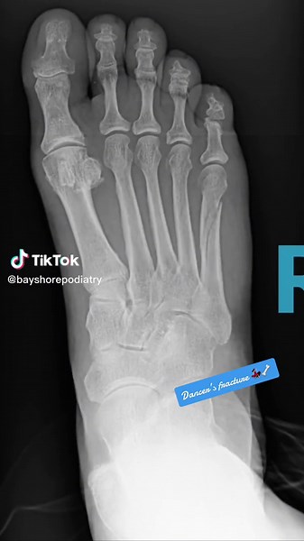 Let’s talk about Dancer’s Fractures 🦶🏻🦴 This is a fracture of the 5th metatarsal shaft that occurs after a sudden twisting motion of the ankle. An injury like this can often be treated without surgery, but requires time to rest and heal! We normally recommend a walking boot for at least 6 weeks 🤕♥️ #footfracture #footpain #footinjury #podiatry #podiatrist #dancers #danceinjury #tampa #tampabay
