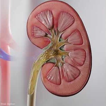 Kidney stones - 3D Animation