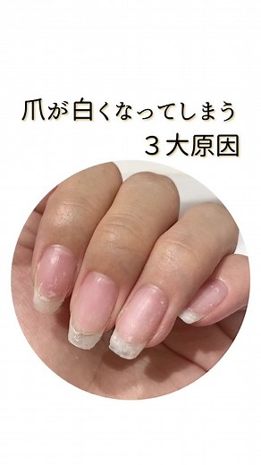 爪が白くなる原因と対策まとめ