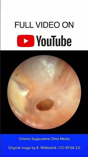 Chronic Suppurative Otitis Media Otoscopy