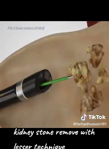 Kidney Stone Removal Using Laser Technique