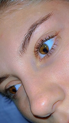 Understanding Coloboma: Causes, Symptoms, and Treatment