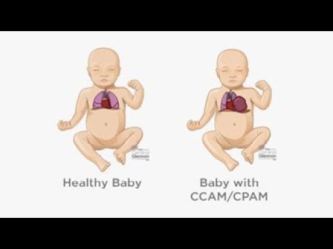 Congenital Pulmonary Airway Malformation CPAM; cystic tissue replaces part of lung