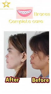 18M views · 34K reactions | Bye bye Braces see u retainers ⭐️thank...