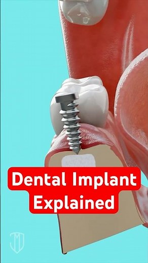 Socket Bone Grafting and Dental Implant Explained #dental #medical #dentist #dentalcare
