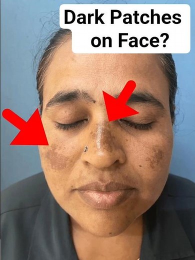 Skin changes after pregnancy- Melasma