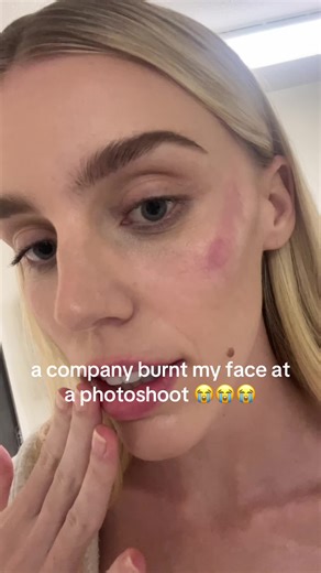 Model Shares Chemical Burn Experience at Photoshoot
