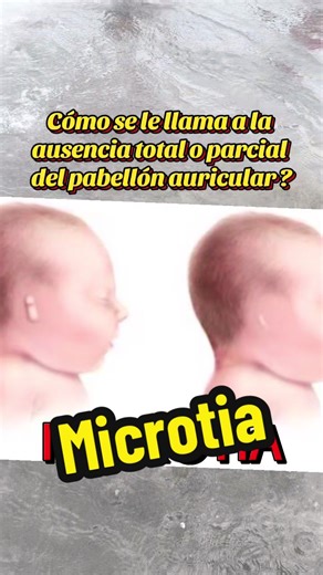 La microtia es una malformación congénita , caracterizada por desarrollar parcial del pabellón auricular hasta la ausencia total llamada también anotia #Microtia #pabellonauricular #oidostapados #oidopequeño #hipoacusiaconductiva