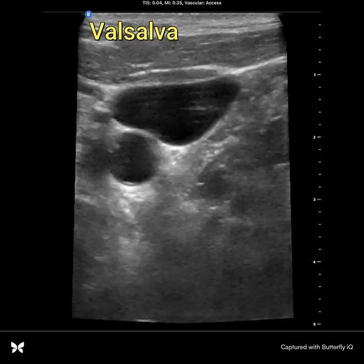 Valsalva Maneuver, Ultrasound, Right Internal Jugular Vein