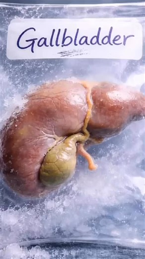 Sara on Instagram: "Gallbladder Surgery ke baad Diet: Kya khayein aur kya nahi? . . . Gallbladder (Pitta ki Thaili) nikalne ke baad kya hota hai? Is video mein hum baat karenge ki Gallbladder removal surgery (Cholecystectomy) ke baad aapki body kaise function karti hai. Bhale hi aapke paas ab ‘Bile storage’ nahi hai, lekin aapka liver ab bhi bile banata hai jo seedhe intestine mein jata hai. Is video mein aap janenge: ✅Gallbladder ka asli kaam kya hai? ✅Surgery ke baad digestion mein kya badlav 