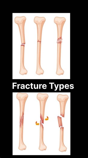Types of Fractures Explained | Simple Compound Comminuted #shorts