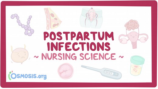 Postpartum infections: Nursing: Video & Causes | Osmosis