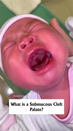 What Is a Submucous Cleft Palate? 👶🩺 #shorts #medical