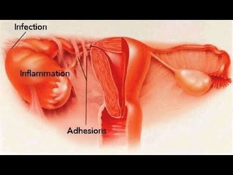 Pelvic Adhesions; bands of scar tissue that form between pelvic organs,