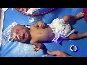 How to Pass an NG Tube in a Baby | Step-by-Step NICU Feeding Tube Guide (Educational)
