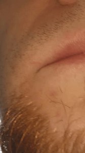 Sore spot, tooth extraction, shooting super macro in a man's mouth. Vertical video.