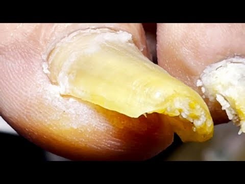Yellow And Long Toenails, Perfect Trimming Process【Pedicure Master Lin Jun】