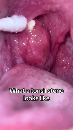 Just Tonsil Stones on TikTok