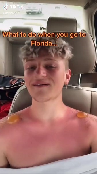 Dealing with Sunburn Blisters in Florida