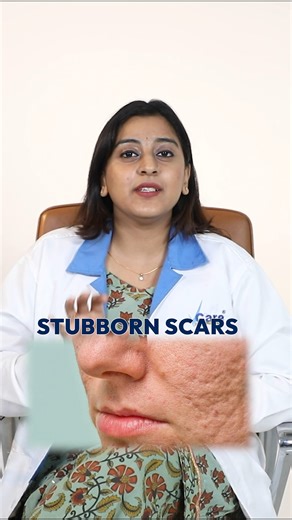 Makeup can hide scars, but what if you could truly heal them? Some scars won’t fade because they need CELLULAR-LEVEL REPAIR. VCare’s EXO GLO uses exosomes to activate your skin’s healing power, regenerating damaged tissue naturally! No chemicals. No downtime. Just real, lasting results! Call 95000 02401 . . . . #VCare #VCareclinics #Exosome #exosometherapy #skinTreatment #autologous #advancedtechnology #FDAapproved #solution #antiageing #pigmentation #wrinkles #stretchmarks #finelinesandwrinkles