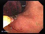 Adenocarcinoma with Signet Ring Cells (3 of 3) • Video • MEDtube.net