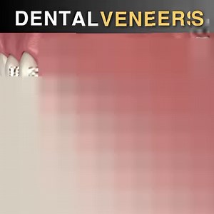 Veneers: Treatment for Chipped Front Teeth #cosmeticdentistry | Dental Daily