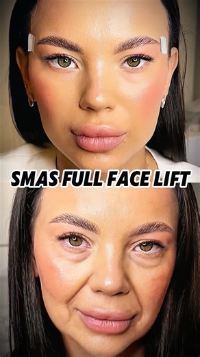 A subtle lift can make the whole face feel lighter. #facelift #naturalresults