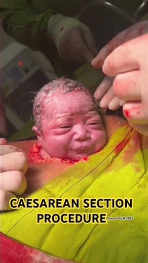 CAESAREAN SECTION PROCEDURE | Paypay | #newborn #memories #babygirl #baby #babyshorts #love #cs