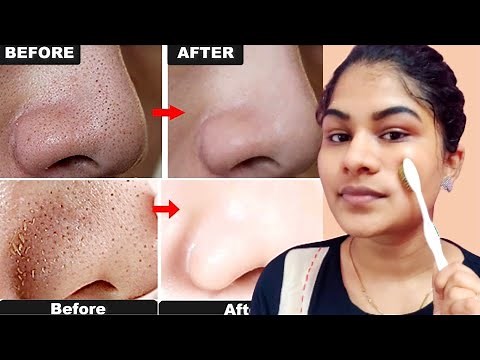 How To Remove Blackheads & Whiteheads From Nose, Chin And Forehead | Beauty tips in Tamil