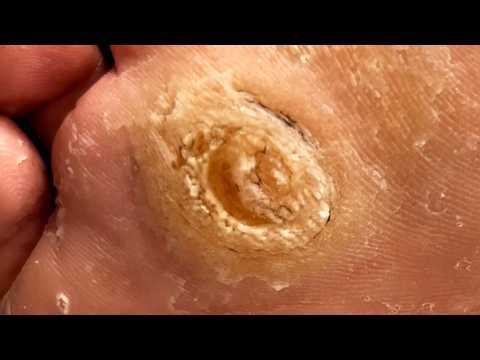 Huge Foot Calluses! Dig Out Hard Objects Foot Peg【Xue Yidao】